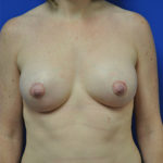 Complex Primary Breast Augmentation
