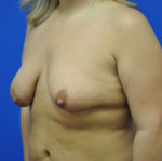 Combination Breast Lift / Augmentation