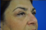 Eyelid Surgery