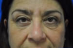 Eyelid Surgery