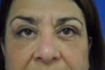 Eyelid Surgery