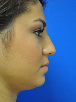Rhinoplasty Case 3680 Before Photo Rhinoplasty