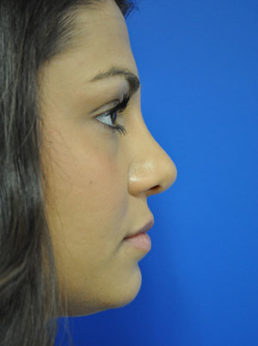 Rhinoplasty Case 3680 After Photo Rhinoplasty