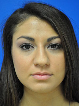 Rhinoplasty Case 3680 Before Photo Rhinoplasty