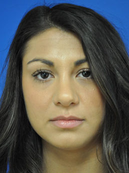 Rhinoplasty Case 3680 After Photo Rhinoplasty