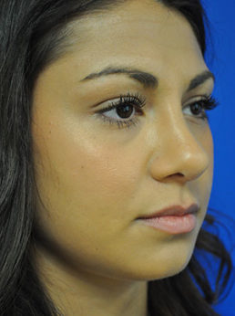 Rhinoplasty Case 3680 After Photo Rhinoplasty