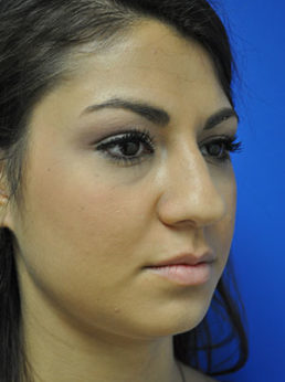 Rhinoplasty Case 3680 Before Photo Rhinoplasty