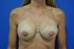 Revisional & Corrective Breast Augmentation