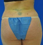 Buttock Shaping (Brazilian Butt Lift)