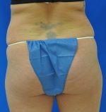 Buttock Shaping (Brazilian Butt Lift)