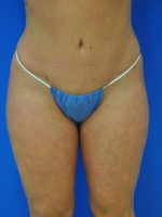 Buttock Shaping (Brazilian Butt Lift)