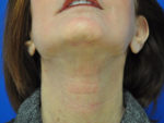 Facelift