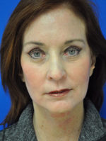 Facelift