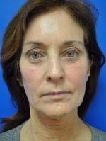 Facelift
