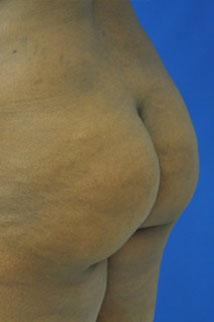 Buttock Shaping (Brazilian Butt Lift) Case 4073 Before Photo Buttock Shaping (Brazilian Butt Lift)