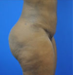 Buttock Shaping (Brazilian Butt Lift)
