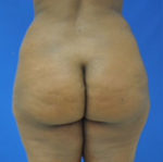 Buttock Shaping (Brazilian Butt Lift)