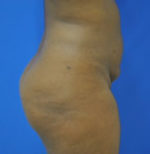 Buttock Shaping (Brazilian Butt Lift)