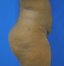 Buttock Shaping (Brazilian Butt Lift) Case 4073 Before Photo Buttock Shaping (Brazilian Butt Lift)
