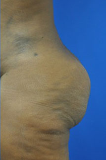 Buttock Shaping (Brazilian Butt Lift) Case 4073 After Photo Buttock Shaping (Brazilian Butt Lift)