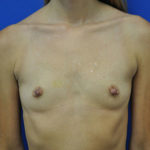 Breast Augmentation