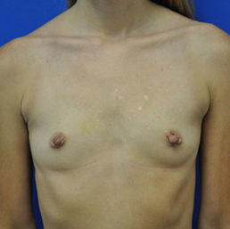 Breast Augmentation Case 4236 Before Photo Breast Augmentation