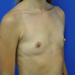 Breast Augmentation Case 4236 Before Photo Breast Augmentation