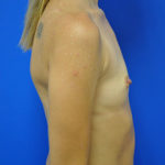 Breast Augmentation