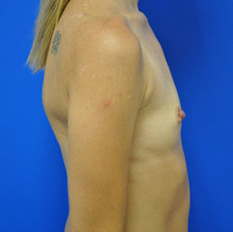 Breast Augmentation Case 4236 Before Photo Breast Augmentation