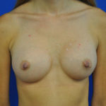 Breast Augmentation