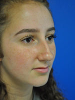 Rhinoplasty