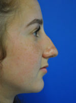Rhinoplasty