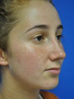 Rhinoplasty