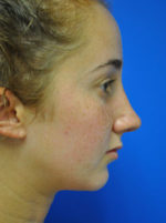 Rhinoplasty