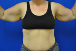Body, Thigh, and Arm Lifts