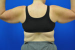 Body, Thigh, and Arm Lifts
