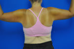 Body, Thigh, and Arm Lifts