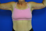 Body, Thigh, and Arm Lifts