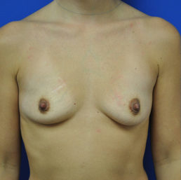 Breast Augmentation Case 4320 Before Photo Breast Augmentation
