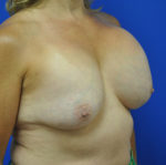 Revisional & Corrective Breast Augmentation
