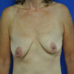 Combination Breast Lift / Augmentation