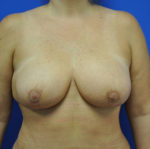 Breast Lift / Mastopexy