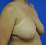 Breast Lift / Mastopexy