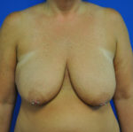 Breast Lift / Mastopexy