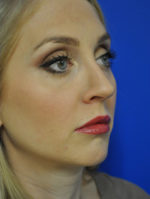 Rhinoplasty
