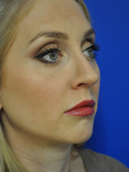 Rhinoplasty Case 4444 After Photo Rhinoplasty
