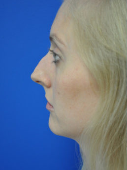 Rhinoplasty Case 4444 Before Photo Rhinoplasty