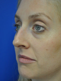 Rhinoplasty Case 4444 Before Photo Rhinoplasty