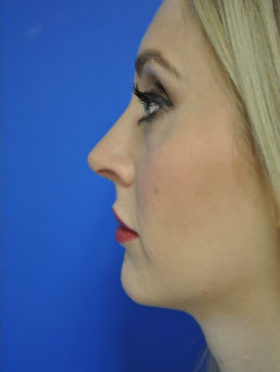 Rhinoplasty Case 4444 After Photo Rhinoplasty