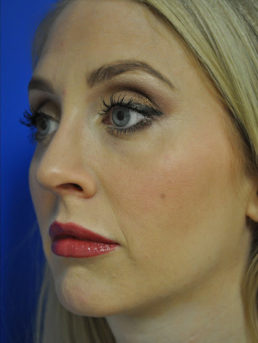 Rhinoplasty Case 4444 After Photo Rhinoplasty